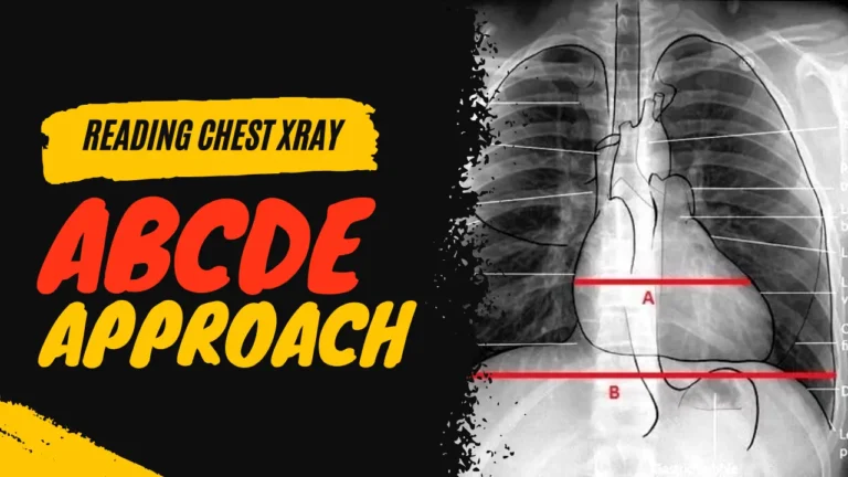 [PPT] How to Read Chest Xray with ABCDE Approach